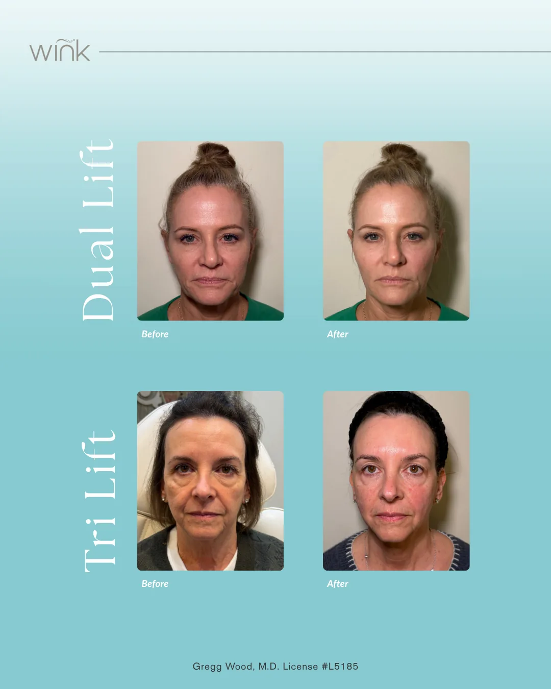 Introducing ​Dual Lift & Tri Lift