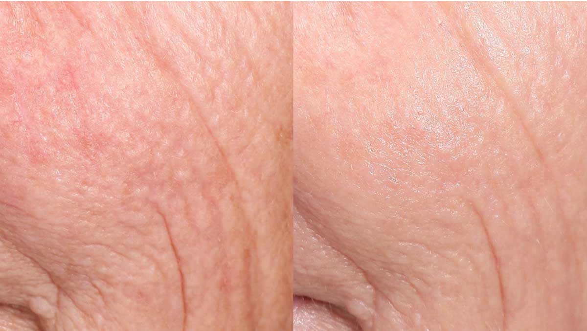 Tribrid closeup before and after