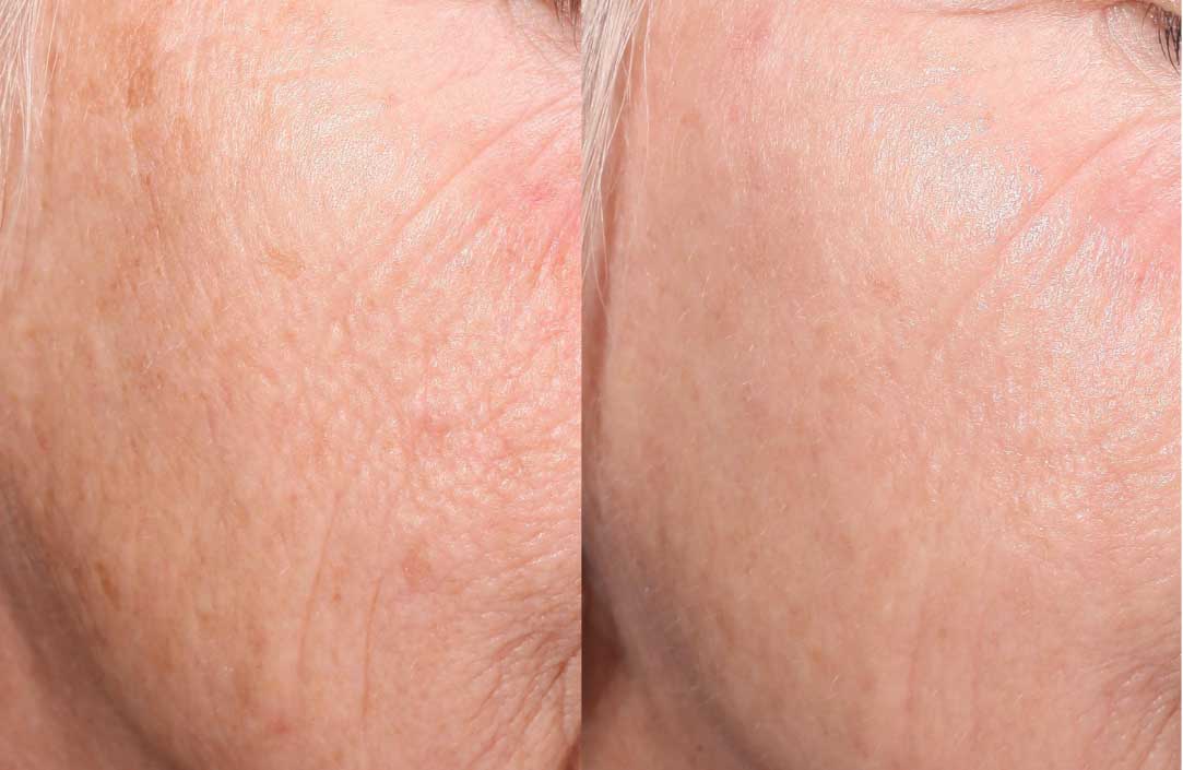 Tribrid closeup left cheek before and after