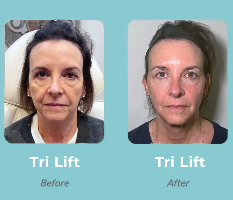 tri lift before and after patient case_1