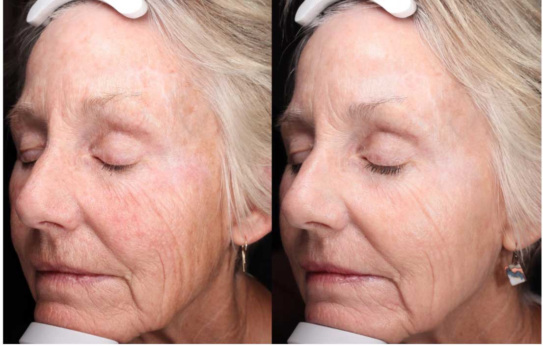 Tribrid before and after